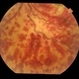 Inflammatory Retinal Vein Occlusion