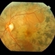 Disseminated Chroroiditis