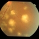 Tubercular choroidal granuloma