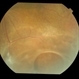 Retinoschisis