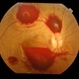 Thrombocytopenia