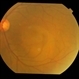 CSCR Subfoveal Leak