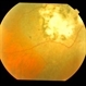 Exudative AMD