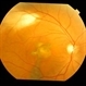 Bilateral Chronic Central Serous Chorioretinopathy