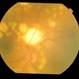 choroidal lymphoma