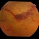 Ischaemic CRVO