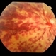 Inflammatory Retinal Vein Occlusion