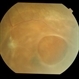 Retinoschisis