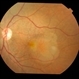 Subfoveal CNVM