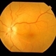 Anterior Ischaemic Optic Neuropathy