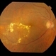 Resolving foveal exudates in diabetic maculopathy