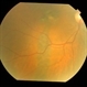 Bilateral Chronic Central Serous Chorioretinopathy