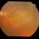 Advanced Wet AMD