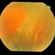 Exudative AMD