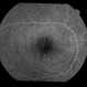 Papilledema