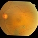 Bilateral Chronic Central Serous Chorioretinopathy