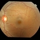 Welding arc maculopathy