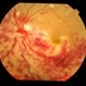 Inflammatory Retinal Vein Occlusion