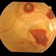Thrombocytopenia