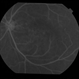 CSCR Subfoveal Leak