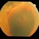 subretinal hemorrhage