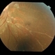 SLE retinopathy