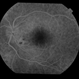 Papilledema
