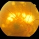 choroidal lymphoma