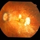 High Myopia with CNVM