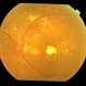 diabetic macular edema