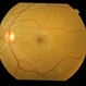 Perifoveal telangiectasia
