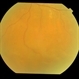 chronic central serous chorioretinopathy