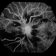 Ischaemic CRVO
