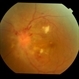hypertensive retinopathy
