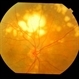 Choroidal Lymphoma
