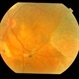 choroidal lymphoma