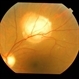 Tubercular choroidal granuloma