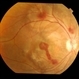 Thrombocytopenia