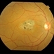 Perifoveal telangiectasia