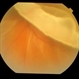 Giant retinal tear
