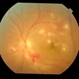 endogenous endophthalmitis following meningitis