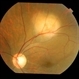 Tubercular choroidal granuloma