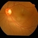 Posterior Scleritis