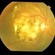 exudative AMD