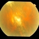 Exudative AMD