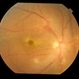 endogenous endophthalmitis following meningitis