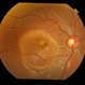 Heredomacular Degeneration