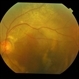 exudative AMD
