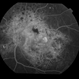 chronic central serous chorioretinopathy