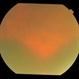 spontaneous submacular hemorrhage